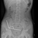 swallowing-magnets-5.jpeg