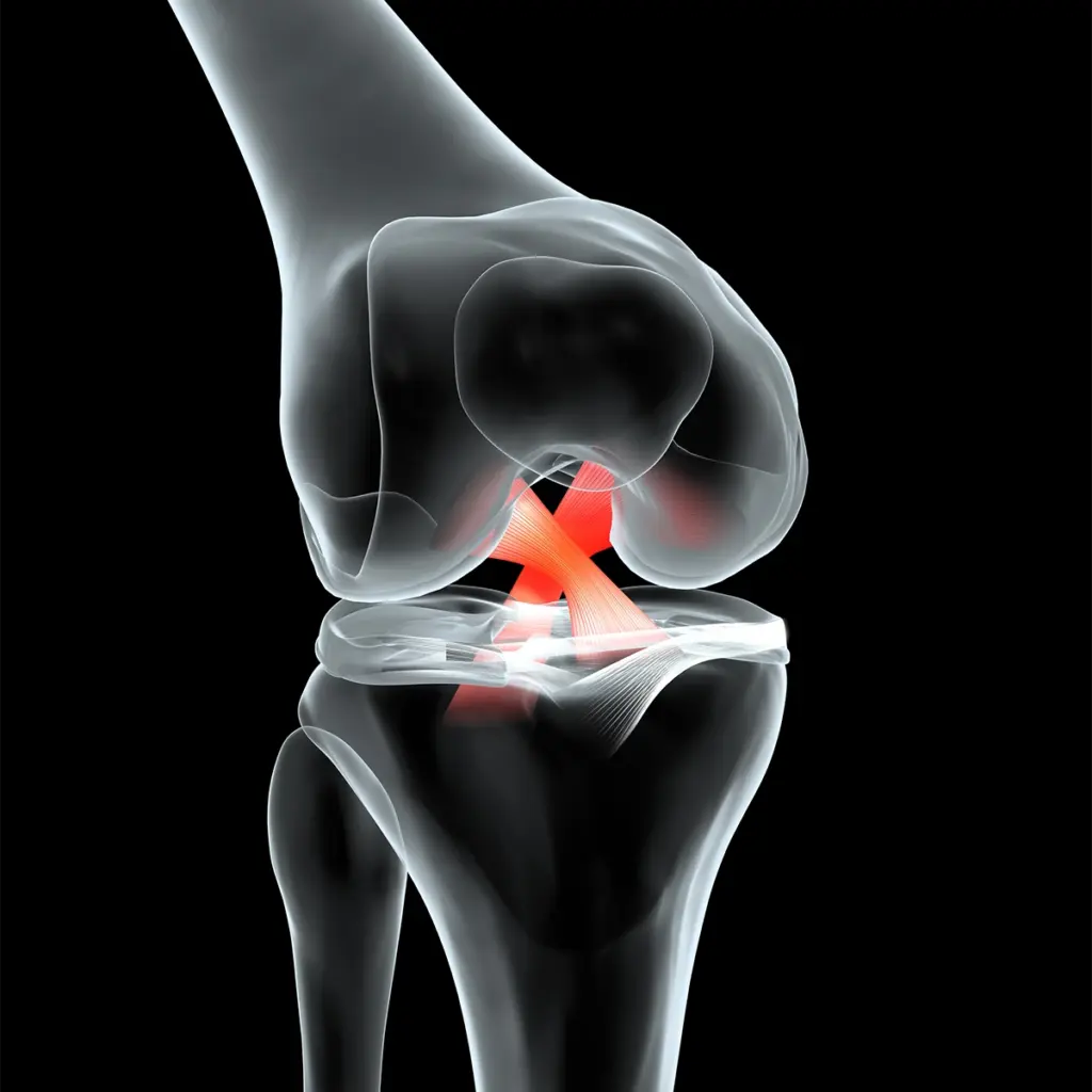acl-injury-218.webp