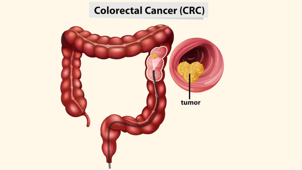 rectal-cancer-34.jpg