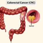 rectal-cancer-34.jpg