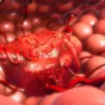 cancer colorectal — CA news