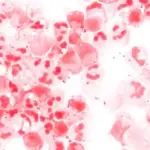 dangerous bacterial infection in canada — CA news