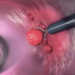 colorectal cancer — CA news